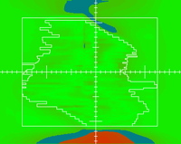 out-of-field dose example