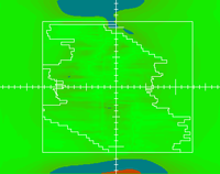 out-of-field dose example