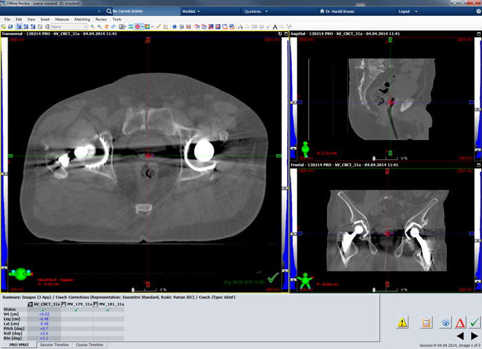 Planning CT showing isocenter planes of session 31.