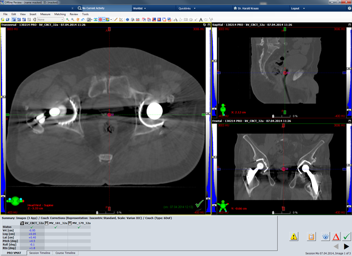 Planning CT showing isocenter planes of session 32.