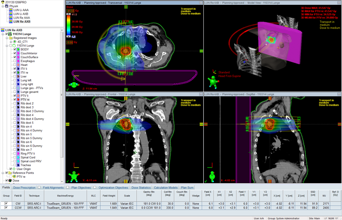 SBRT plan right lung