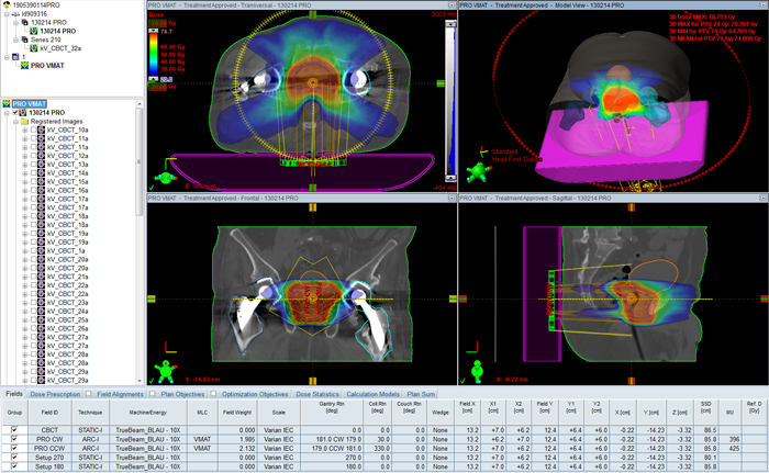 VMAT treatment plan with two acoidance sectors.