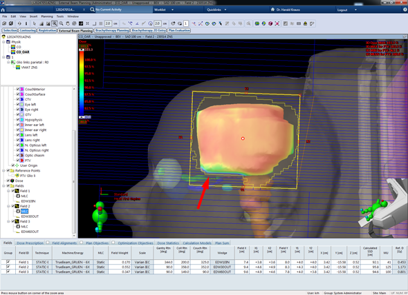 Optimal solution, PTV surface dose reveal the regions of low PTW dose