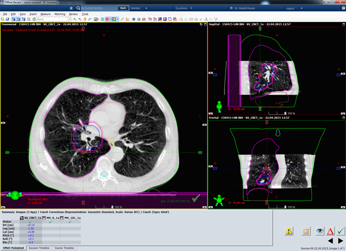 CBCT of Thorax IBH