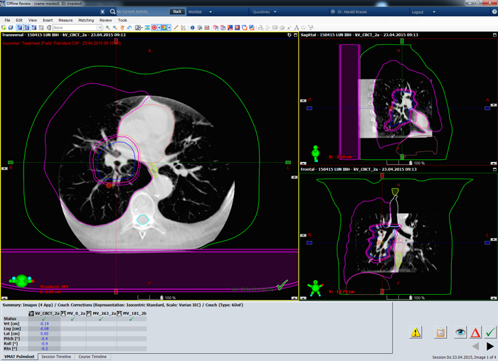 CBCT of Thorax IBH