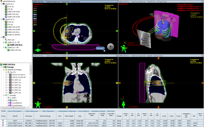 SABR of lung upper lobe