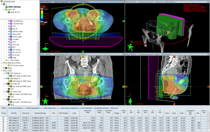 Anal cancer, clinical plan with three arcs