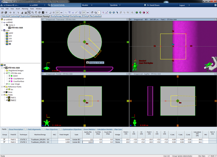 Start of shadowing in Eclipse; uncorrected PTW dataset