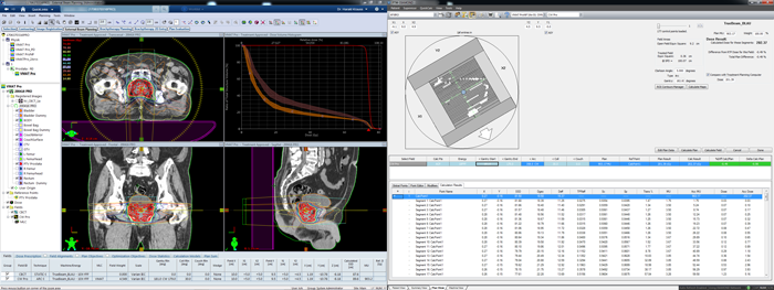 Optimized Planning Workflow: RapidPlan plus DIAMOND