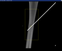 DRR showing a copper wire from the 403 overlay running diagonally through the image.