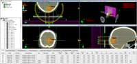 Homogeneous plan, optimized and calculated with AAA