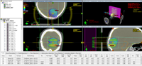 Inhomogeneous dose after recalculation with AXB field dose