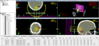 Homogeneous plan, recalculated with AXB plan dose